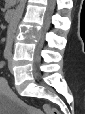 CT_CT SPINE LUMBOSACRAL_L SPINE SAGITTAL SOFT THICK_2023-03-14