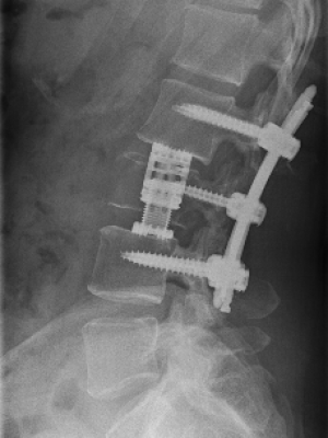 DX_XR SPINE LUMBOSACRAL_W LUMBAR SPINE LAT_2023-05-31