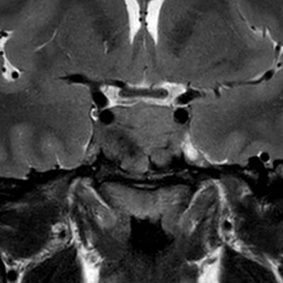MR_MRI BRAIN_COR T2 PSS_2020-07-09