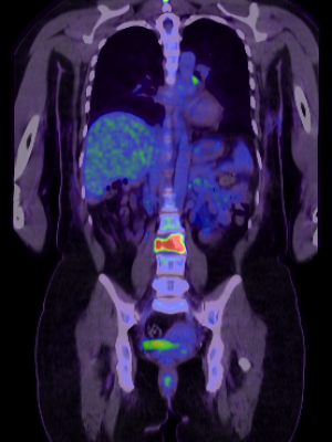 PT_PT FDG TORSO+DIAG CT_MPR 5MM COR FUSED_2023-03-16