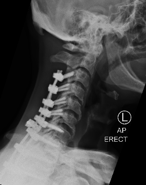 DX_XRAY CERVICO-THORACIC SPINE_AP OPEN MOUTH_2020-08-13