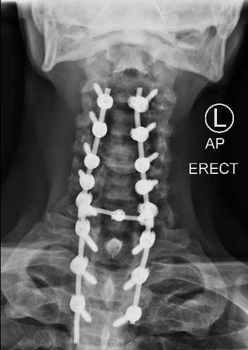 DX_XRAY CERVICO-THORACIC SPINE_AP_2020-08-13
