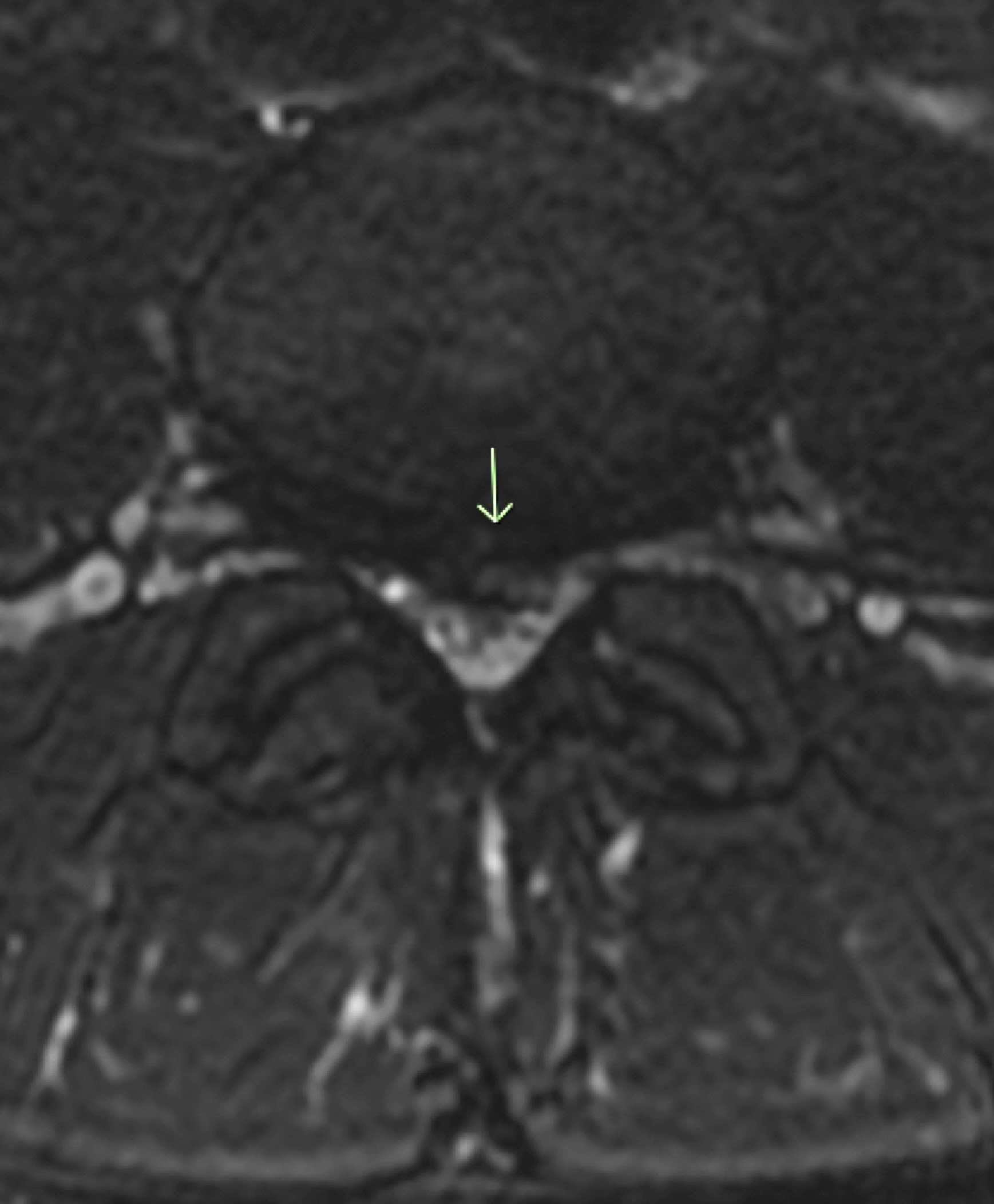 MRI T2 Ax