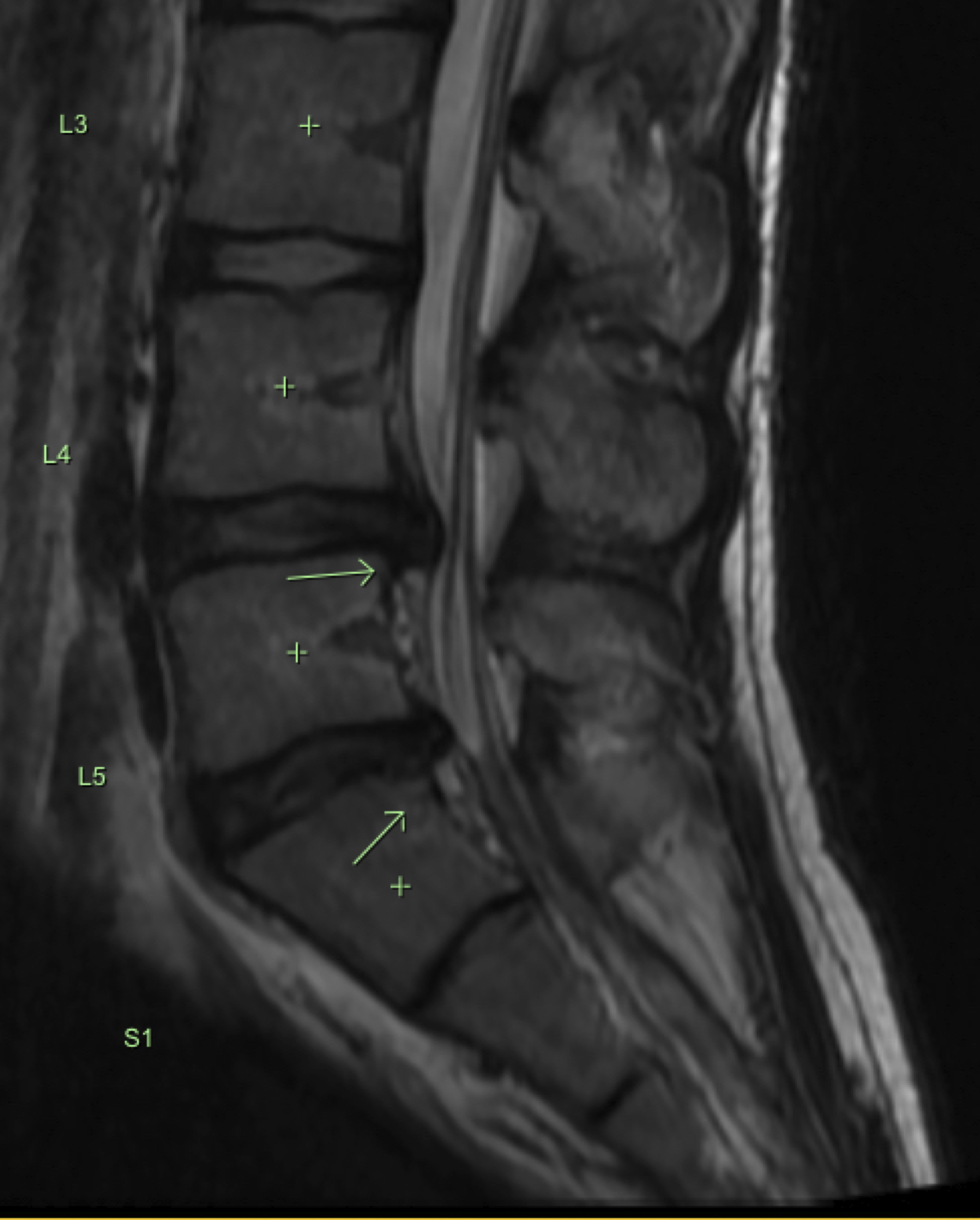 MRI T2 Sag