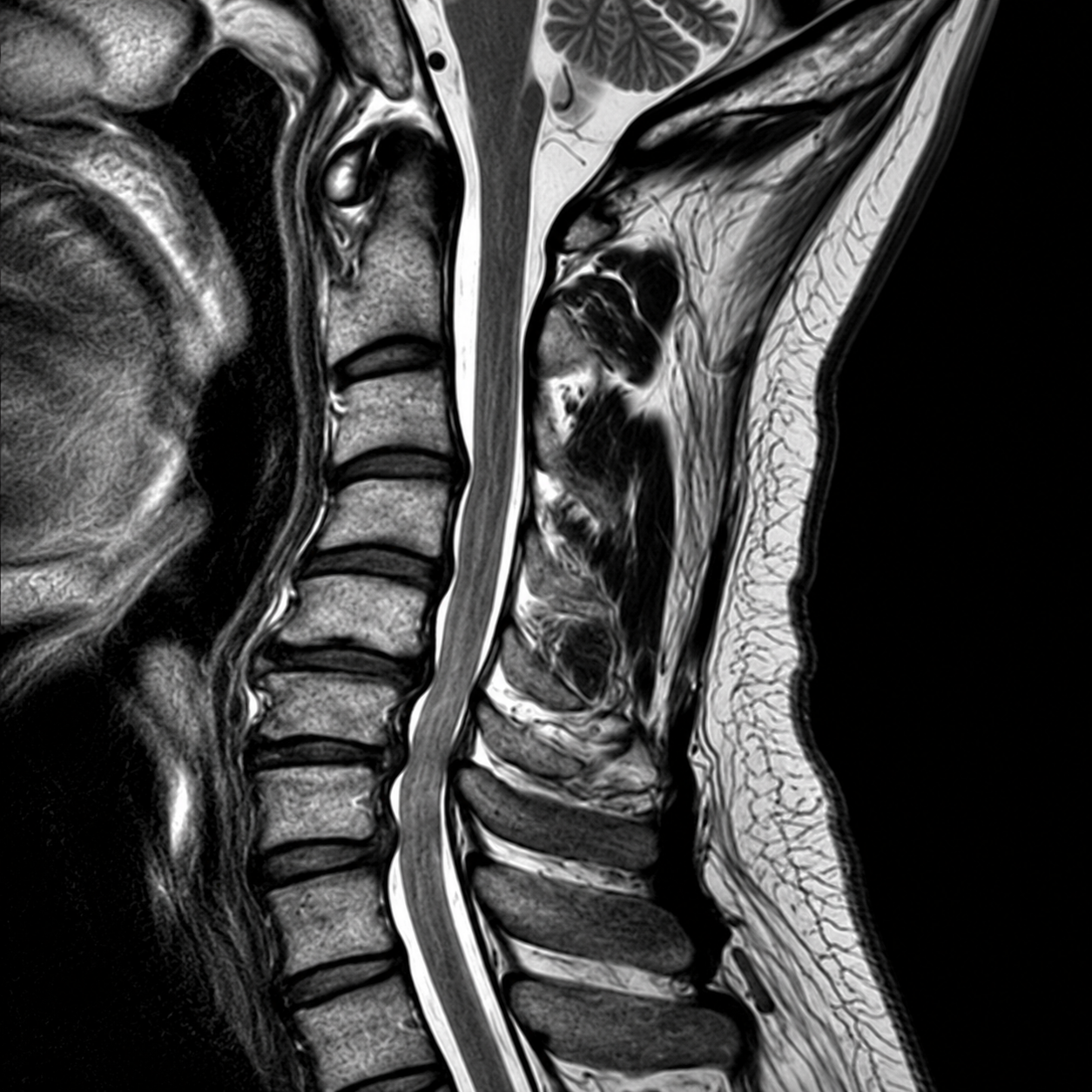 MR_MRI-CERVICAL-SPINE_T2-SAG