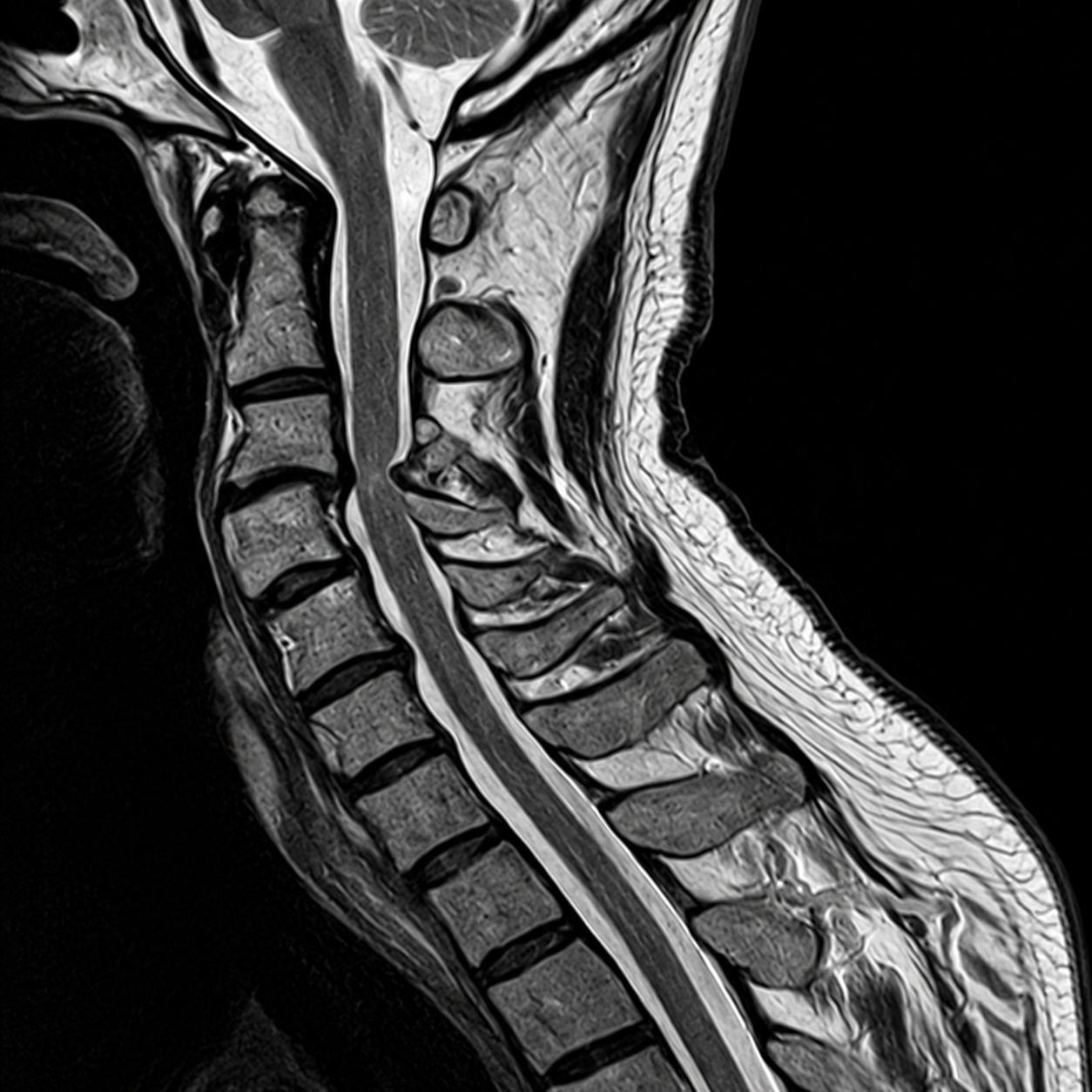 MR_MR-SPINE-CERVICAL_T2_TSE_SAG_2025-